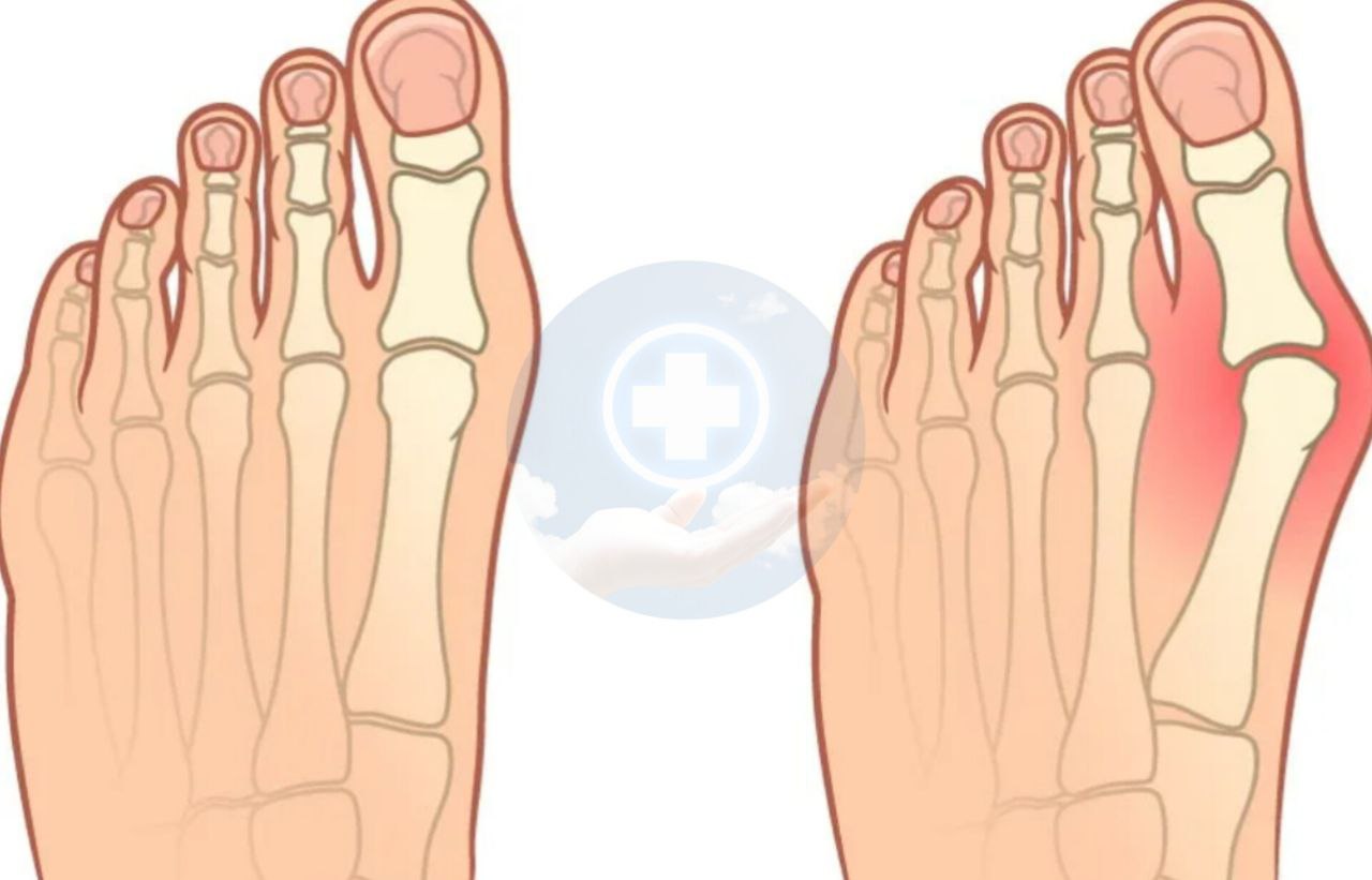 Указательный палец на ноге. Болит косточка на мизинце ноги. Разделитель большого пальца ноги при вальгусной деформации. Деформация тейлора 5 плюсневой. 4 и 5 палец стопы.