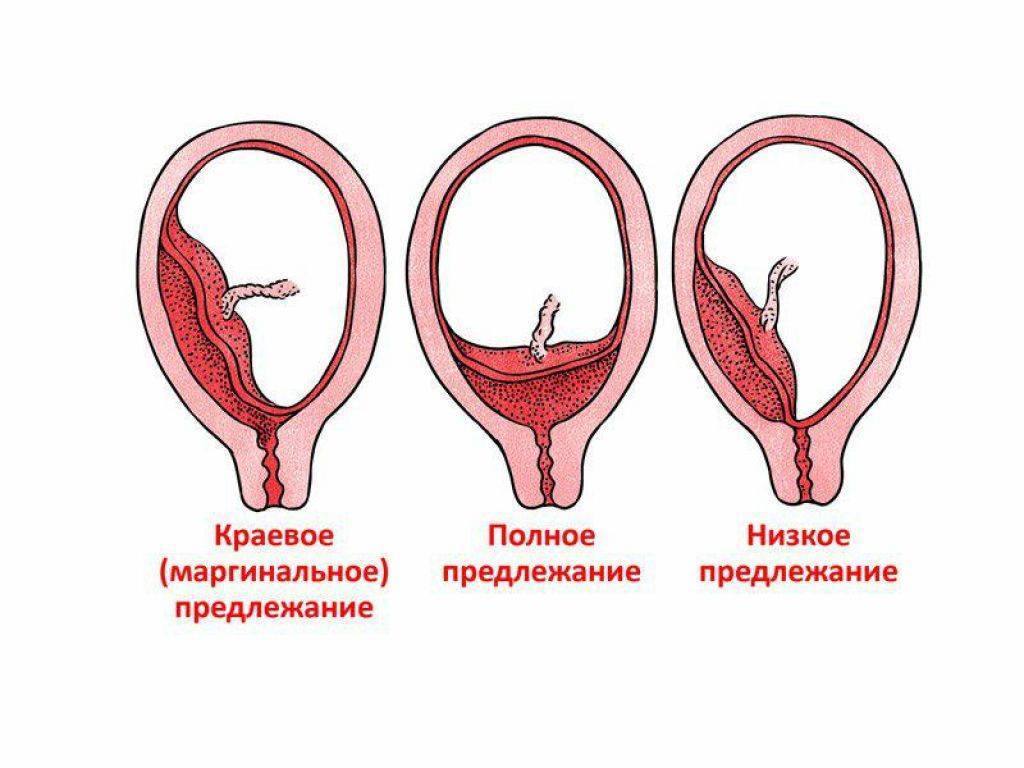 Низкая плацентация 20 недель по передней стенке